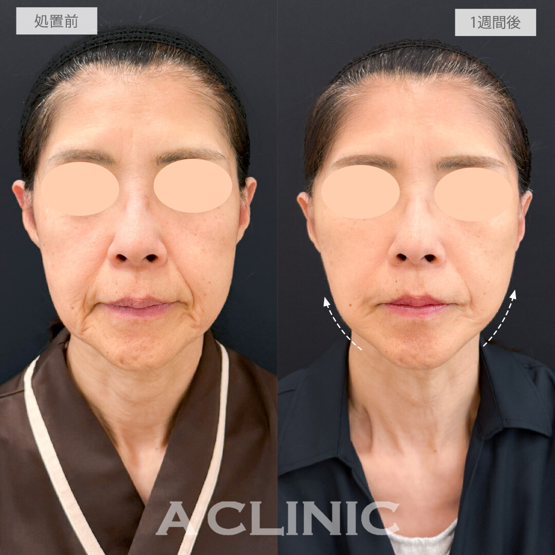 A式たるみ切開であっという間に若返りました！処置前と1週間後の症例です(60代女性)