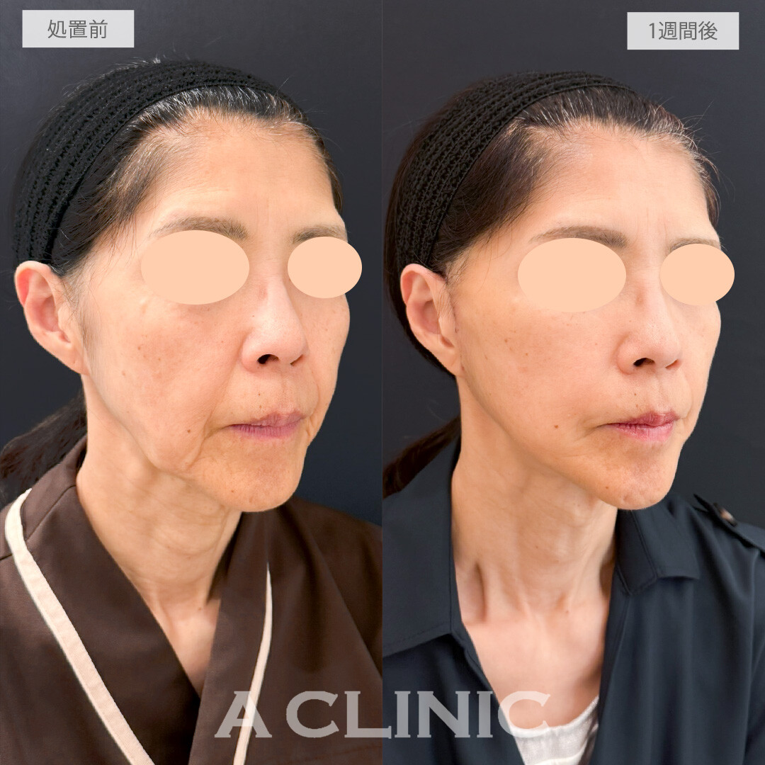 A式たるみ切開であっという間に若返りました！処置前と1週間後の症例です(60代女性)