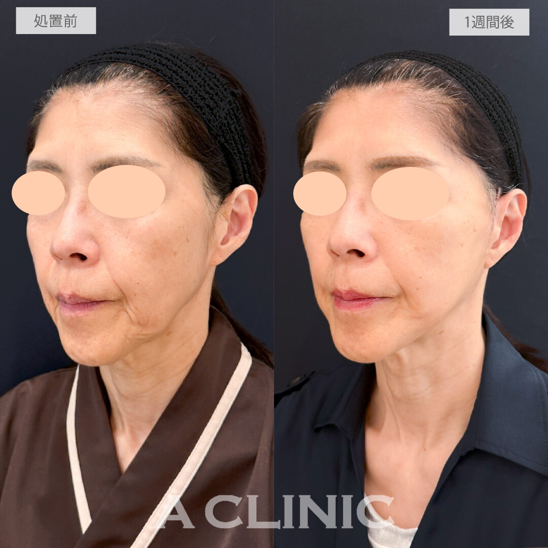 A式たるみ切開であっという間に若返りました！処置前と1週間後の症例です(60代女性)