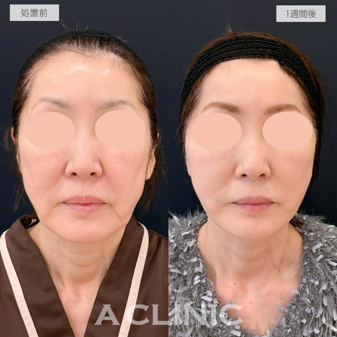 A式たるみ切開はたるんで歪んでしまった輪郭もしっかり引き上げ若々しさを取り戻せます！処置前と1週間後の症例です(50代女性)