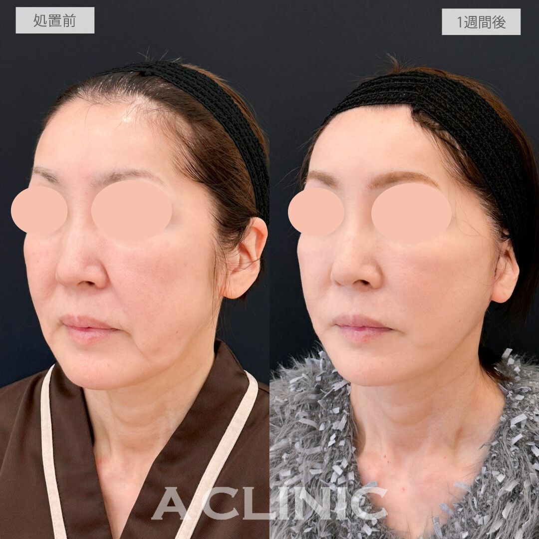 A式たるみ切開はたるんで歪んでしまった輪郭もしっかり引き上げ若々しさを取り戻せます！処置前と1週間後の症例です(50代女性)