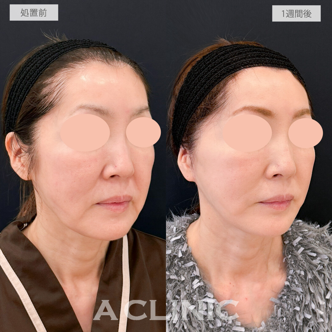 A式たるみ切開はたるんで歪んでしまった輪郭もしっかり引き上げ若々しさを取り戻せます！処置前と1週間後の症例です(50代女性)