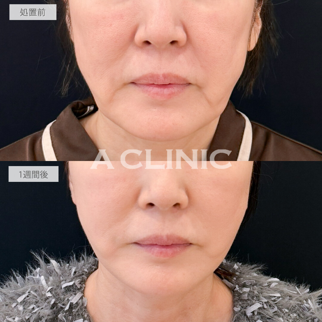 A式たるみ切開はたるんで歪んでしまった輪郭もしっかり引き上げ若々しさを取り戻せます！処置前と1週間後の症例です(50代女性)