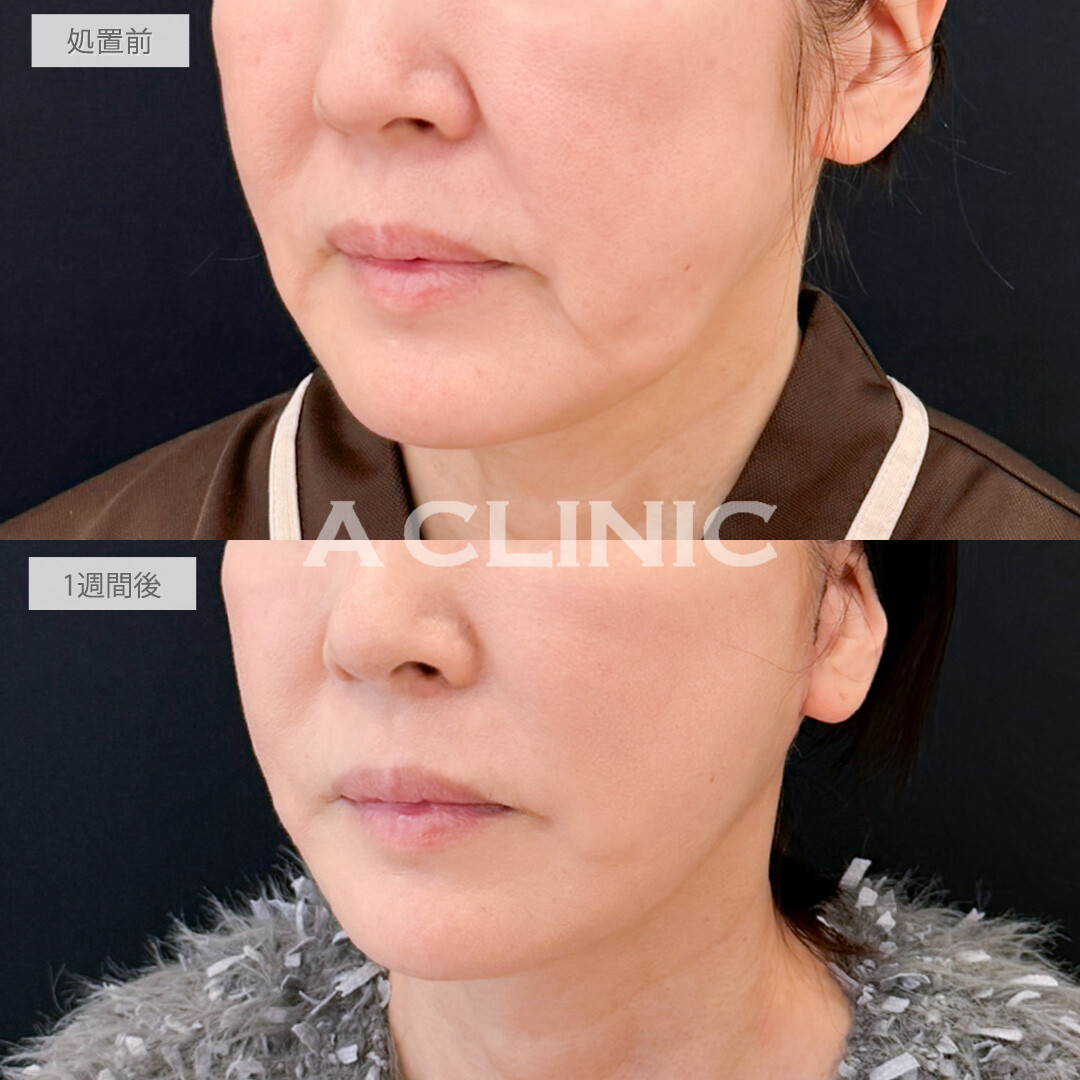 A式たるみ切開はたるんで歪んでしまった輪郭もしっかり引き上げ若々しさを取り戻せます！処置前と1週間後の症例です(50代女性)