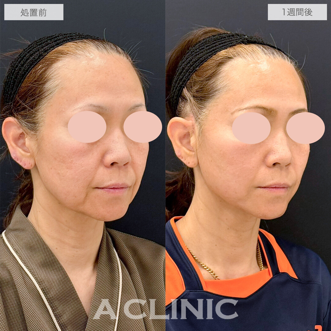 A式たるみ切開で若返りと小顔効果！処置前と1週間後の症例です(50代女性)