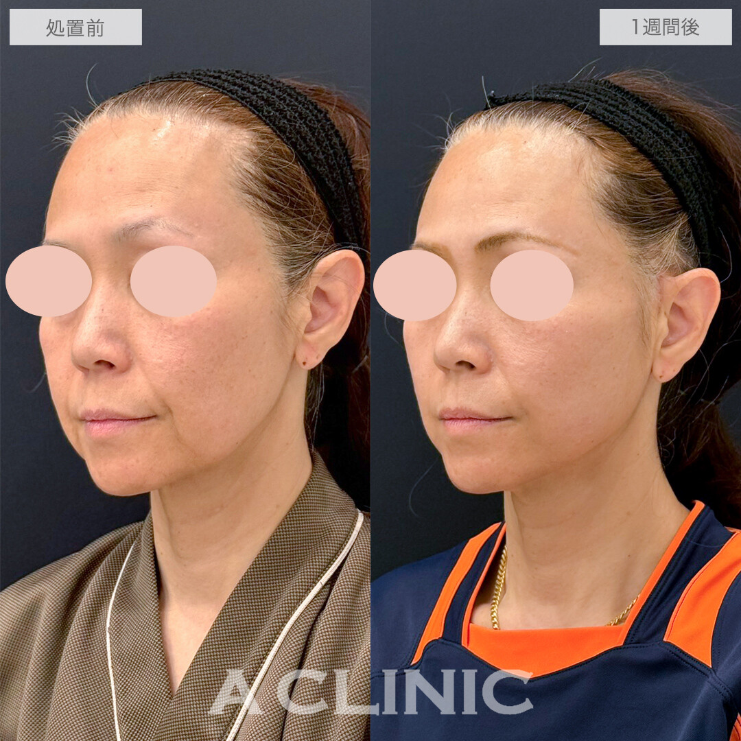 A式たるみ切開で若返りと小顔効果！処置前と1週間後の症例です(50代女性)