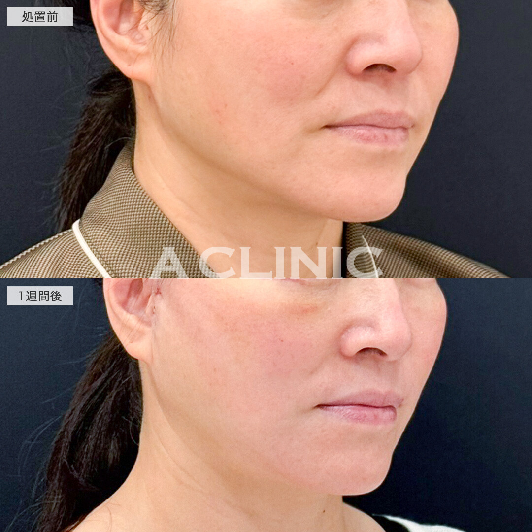 A式たるみ切開でほうれい線が薄くなりました！こちら処置前と1週間後の症例です(50代女性)