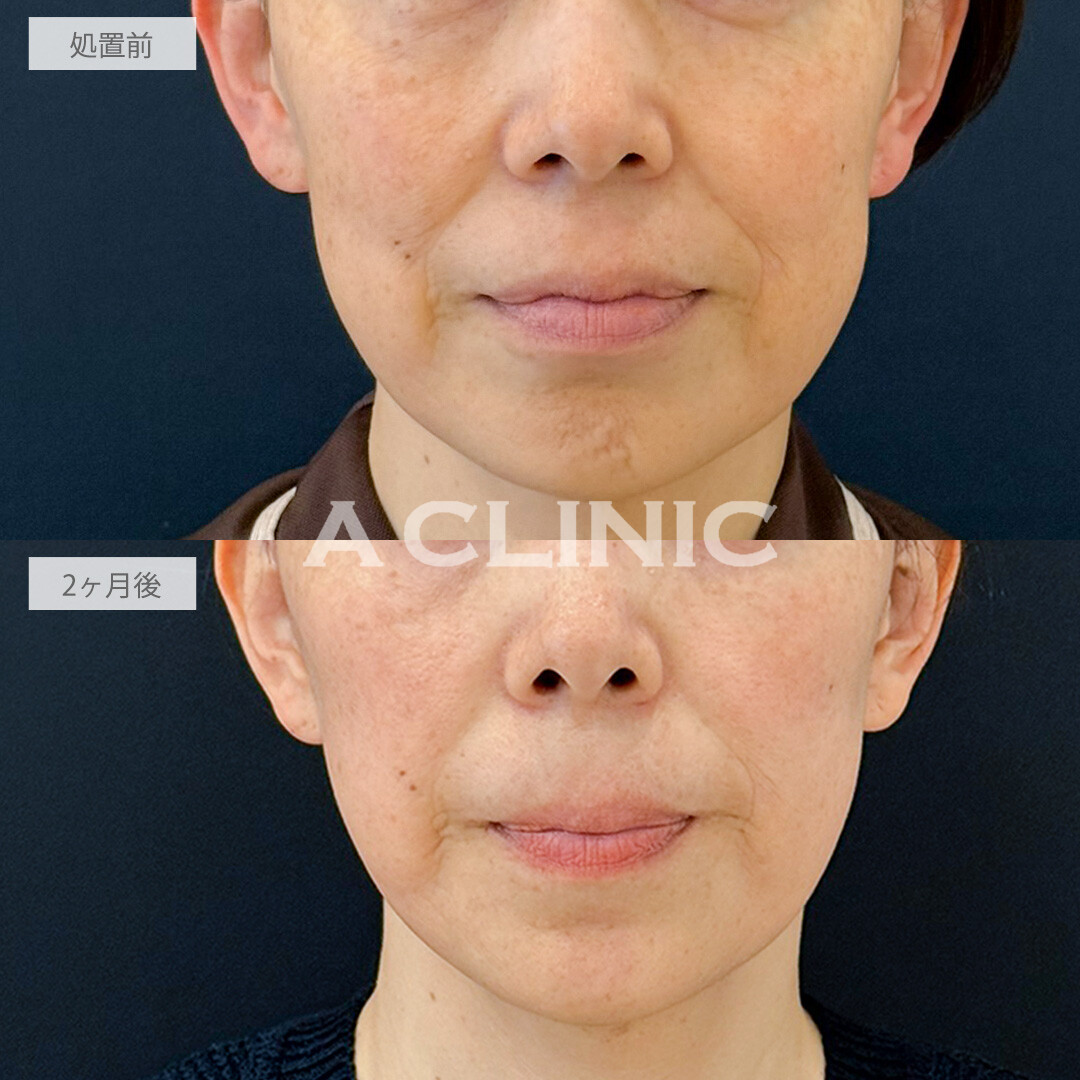 A式たるみ切開でほうれい線が薄くなりました！こちら処置前と2ヶ月後の症例です(40代女性)
