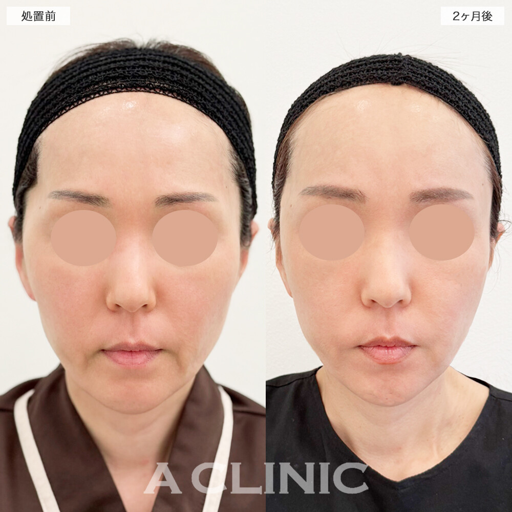 A式たるみ切開で口横のたるみもすっきりしました！処置前と2ヶ月後の症例です(40代女性)