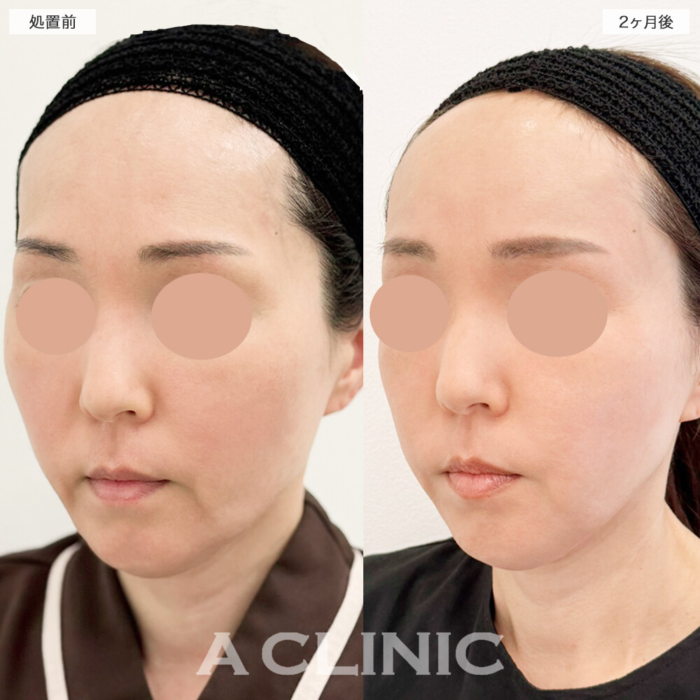 A式たるみ切開で口横のたるみもすっきりしました！処置前と2ヶ月後の症例です(40代女性)