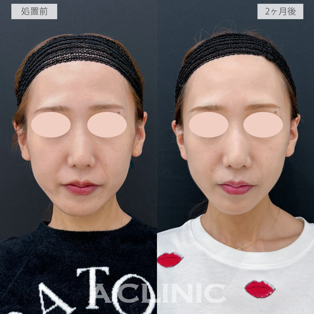 A式たるみ切開でほうれい線が薄くなり若々しい印象に！こちら処置前と2ヶ月後の症例です(30代女性)