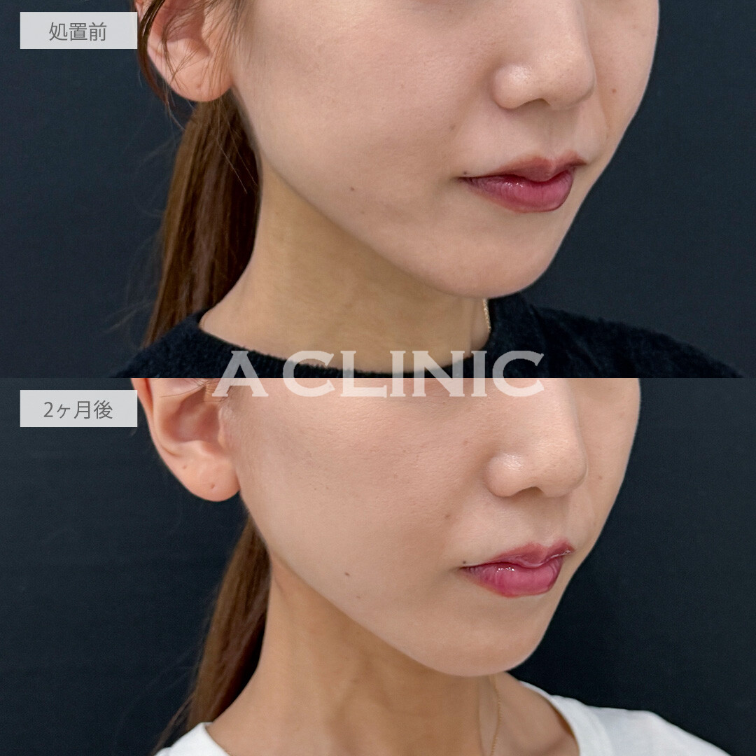 A式たるみ切開でほうれい線が薄くなり若々しい印象に！こちら処置前と2ヶ月後の症例です(30代女性)