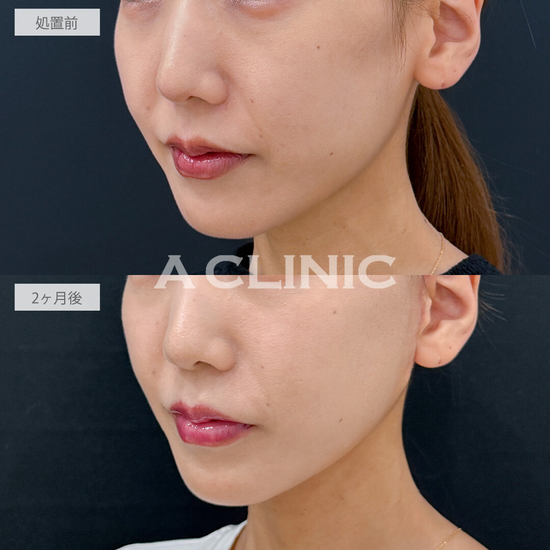 A式たるみ切開でほうれい線が薄くなり若々しい印象に！こちら処置前と2ヶ月後の症例です(30代女性)