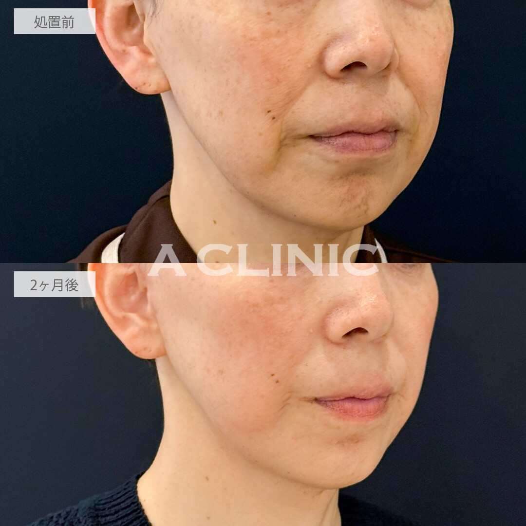 A式たるみ切開でほうれい線が薄くなりました！こちら処置前と2ヶ月後の症例です(40代女性)