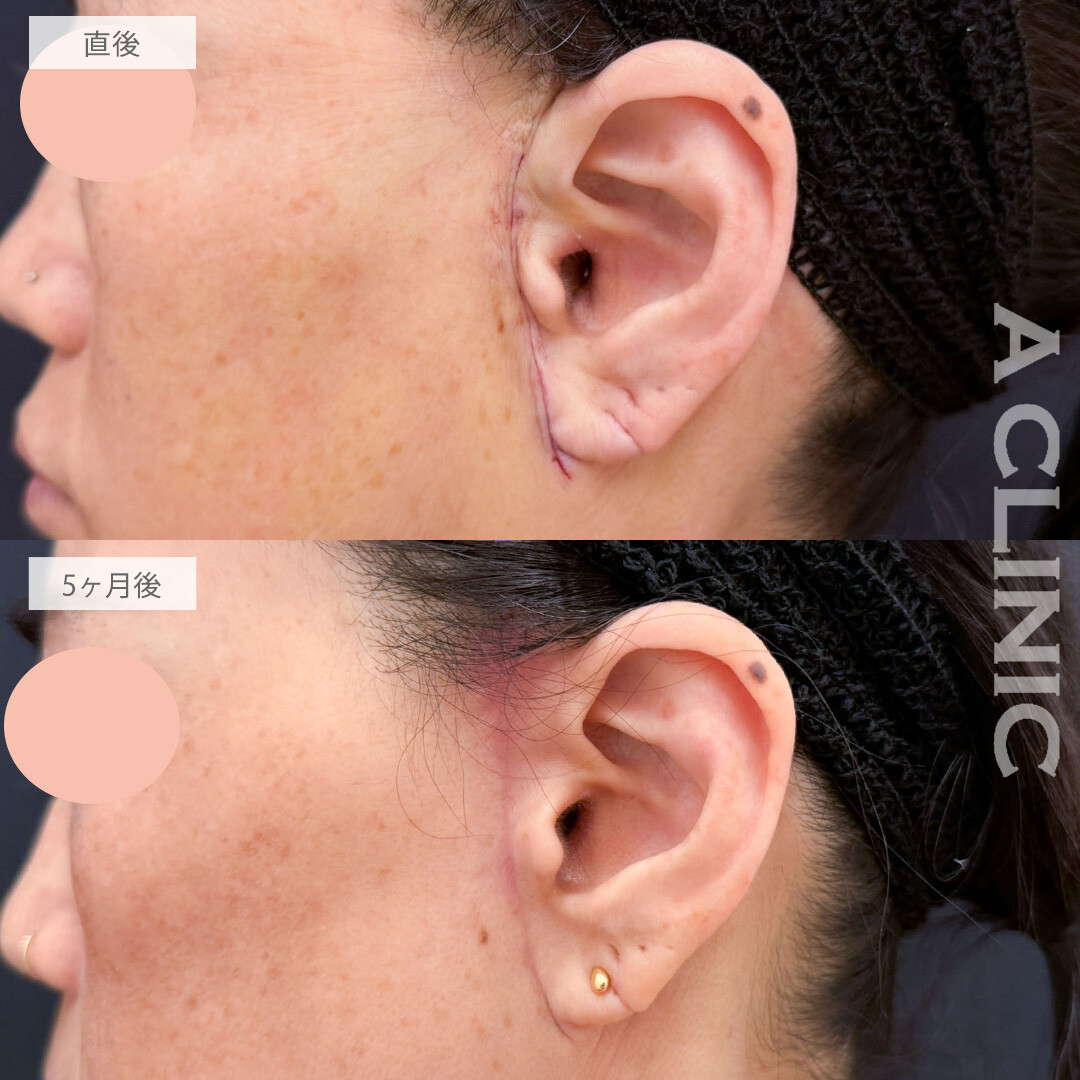 【直後の傷跡あり】A式たるみ切開は上品で自然な若返りを叶えます！こちら処置前と5か月後の症例です(50代女性)