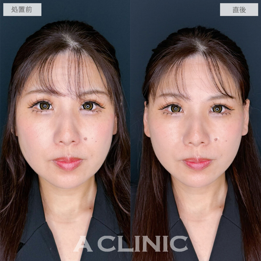 A式たるみ切開で年齢を感じさせるたるみをナチュラルに解消！こちら処置前と直後の症例です(40代女性)