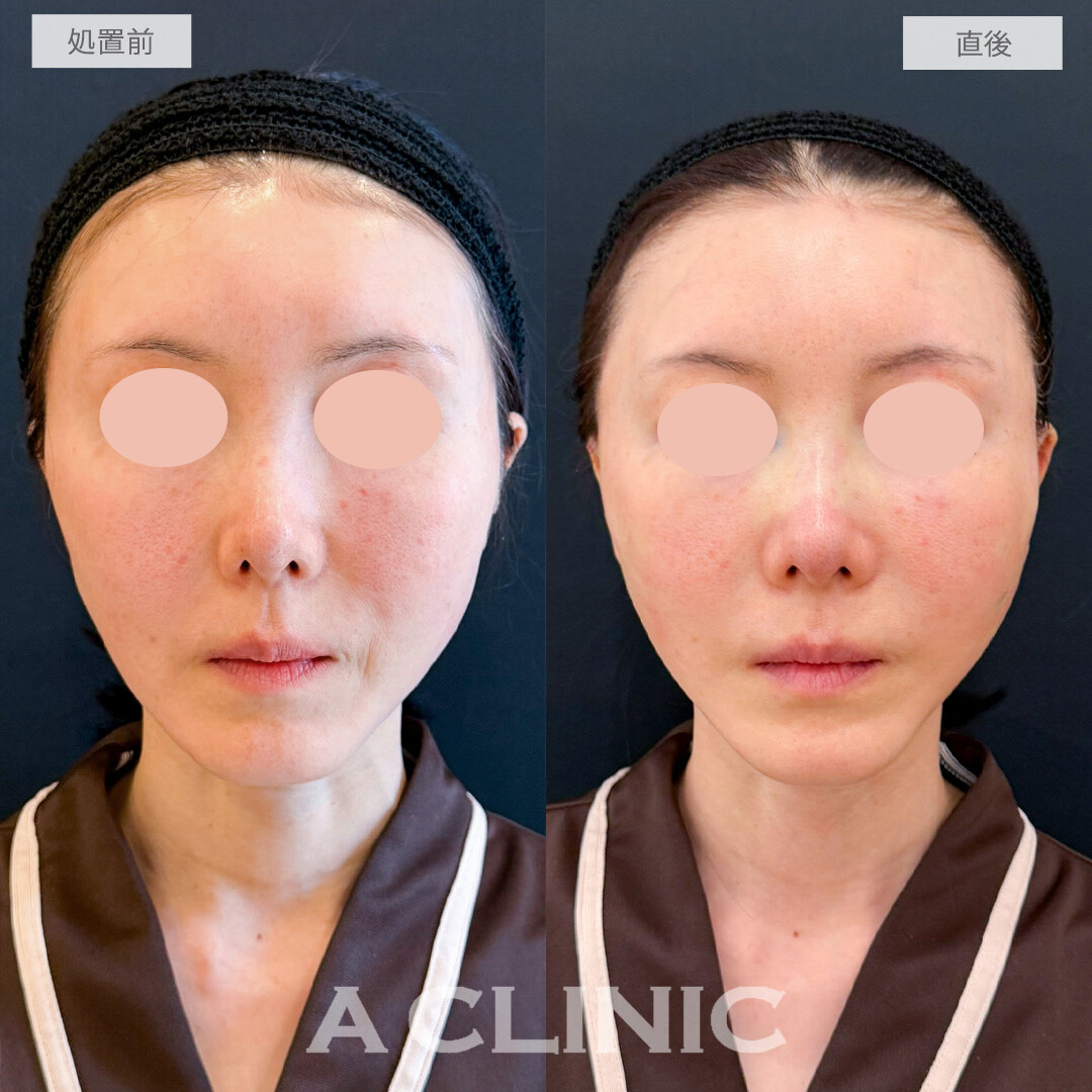 A式たるみ切開で驚くほどナチュラルに若返り！こちら処置前と直後の症例です(50代女性)