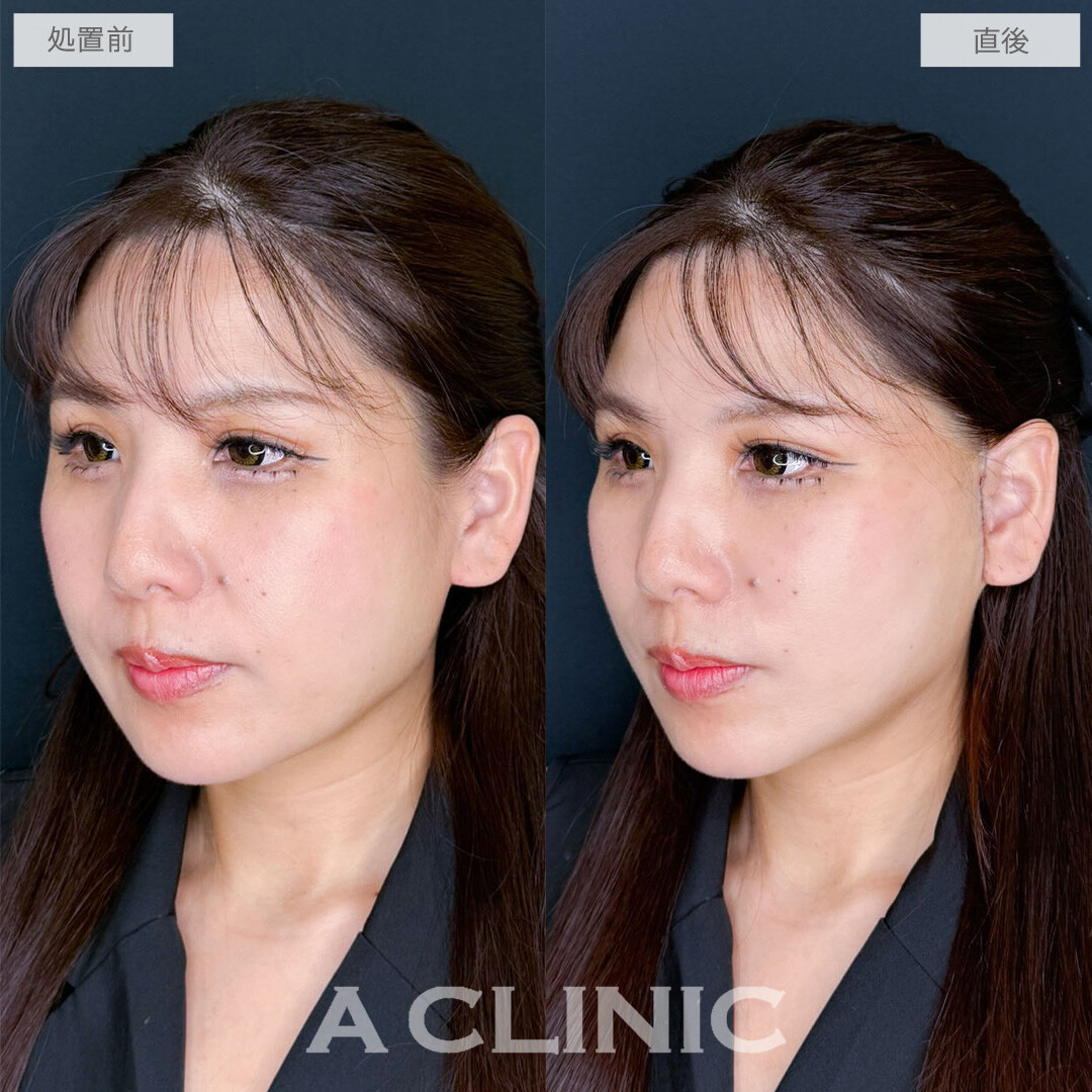 A式たるみ切開で年齢を感じさせるたるみをナチュラルに解消！こちら処置前と直後の症例です(40代女性)