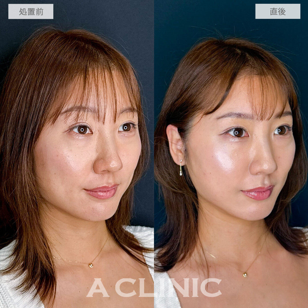A式たるみ切開で30代のたるみをナチュラルに若々しく整えました！こちら処置前と直後の症例です(30代女性)