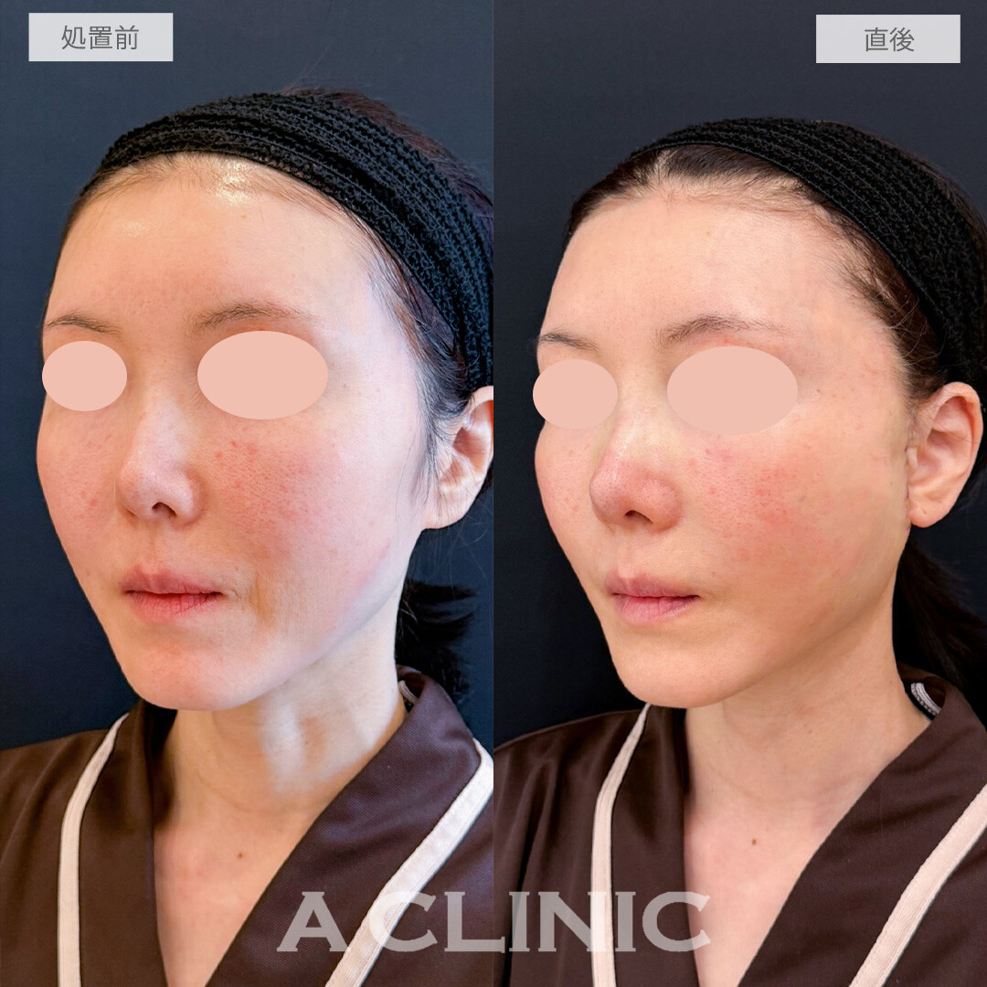 A式たるみ切開で驚くほどナチュラルに若返り！こちら処置前と直後の症例です(50代女性)