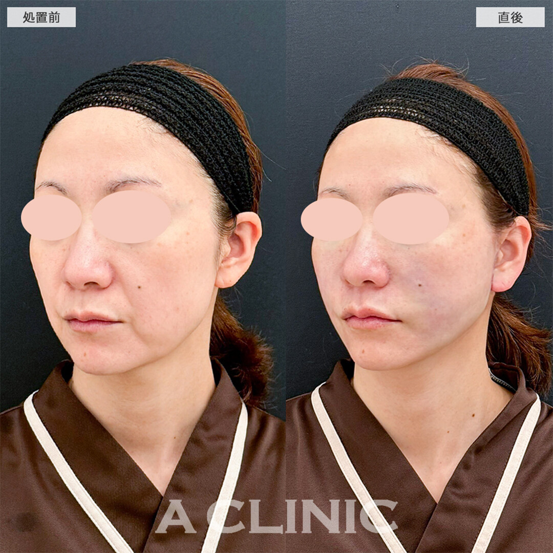 A式ナゾラリフトで中顔面も短縮し若返り大成功！こちら処置前と直後の症例です(40代女性)