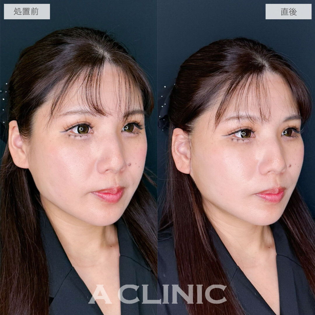 A式たるみ切開で年齢を感じさせるたるみをナチュラルに解消！こちら処置前と直後の症例です(40代女性)