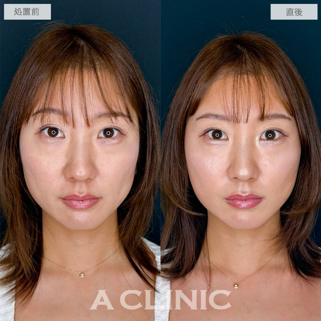 A式たるみ切開で30代のたるみをナチュラルに若々しく整えました！こちら処置前と直後の症例です(30代女性)
