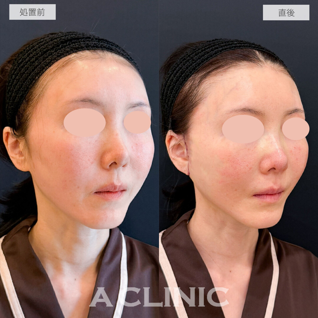 A式たるみ切開で驚くほどナチュラルに若返り！こちら処置前と直後の症例です(50代女性)