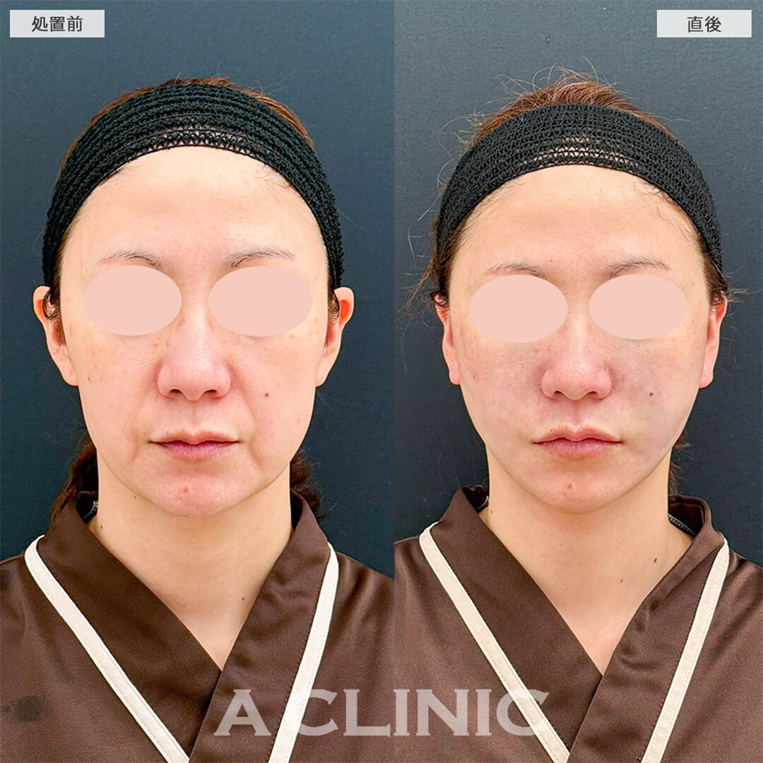 A式ナゾラリフトで中顔面も短縮し若返り大成功！こちら処置前と直後の症例です(40代女性)