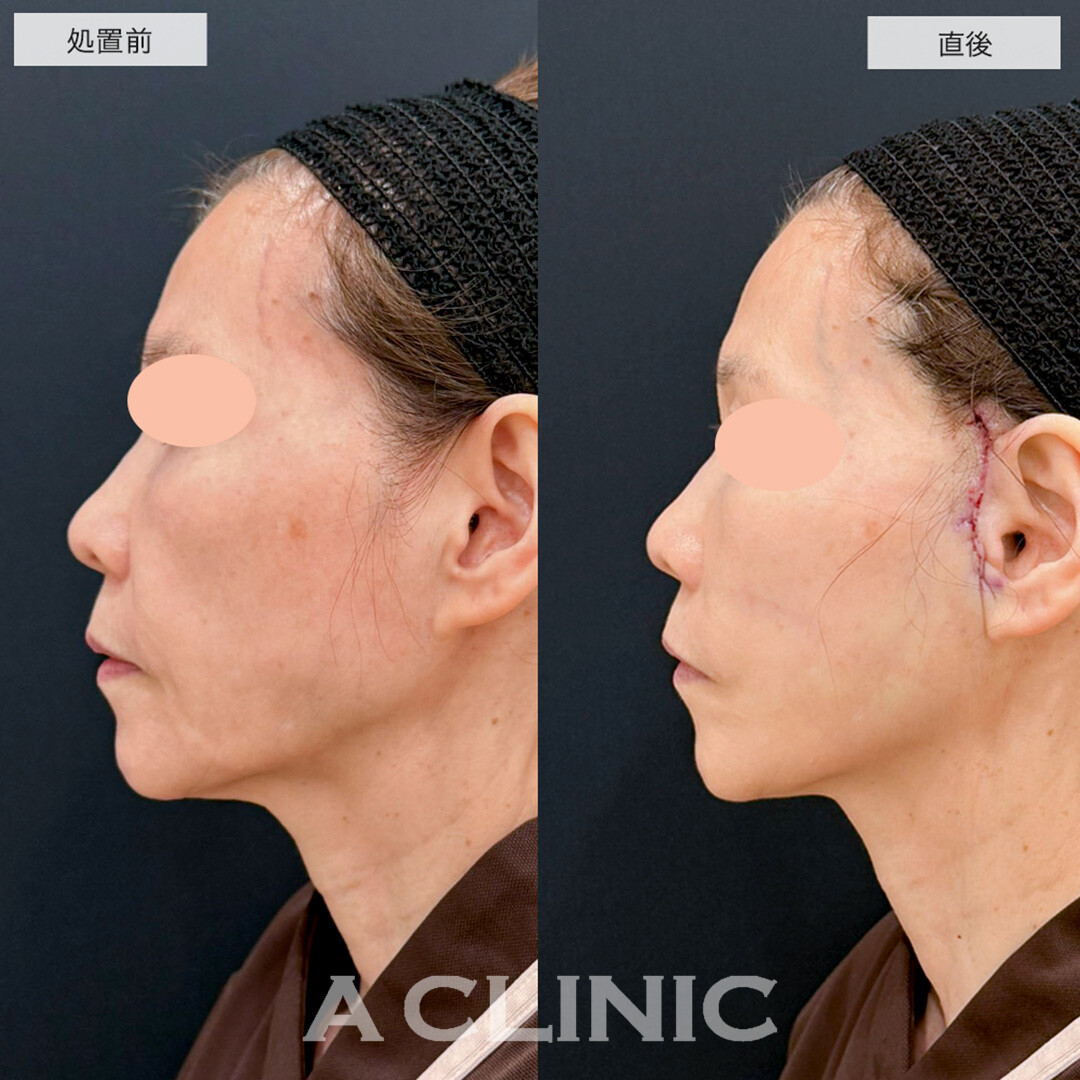 【直後の傷跡あり】A式たるみ切開で根本的なたるみ改善が叶います!こちら処置前と直後の症例です!(60代女性)