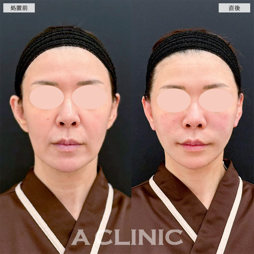 A式ナゾラリフトでほうれい線も無くなり10年前の自分へ！こちら処置前と直後の症例です(40代女性)