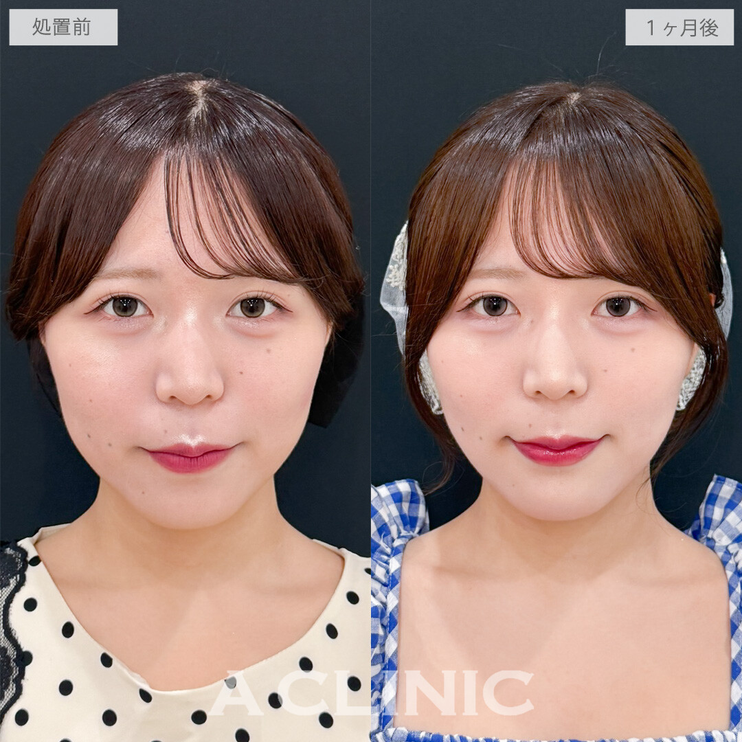 1day小顔脂肪吸引とあごへのヒアルロン酸注入で顔のバランスを整えて可愛さアップ！処置前と直後の1ヶ月後です(20代女性)