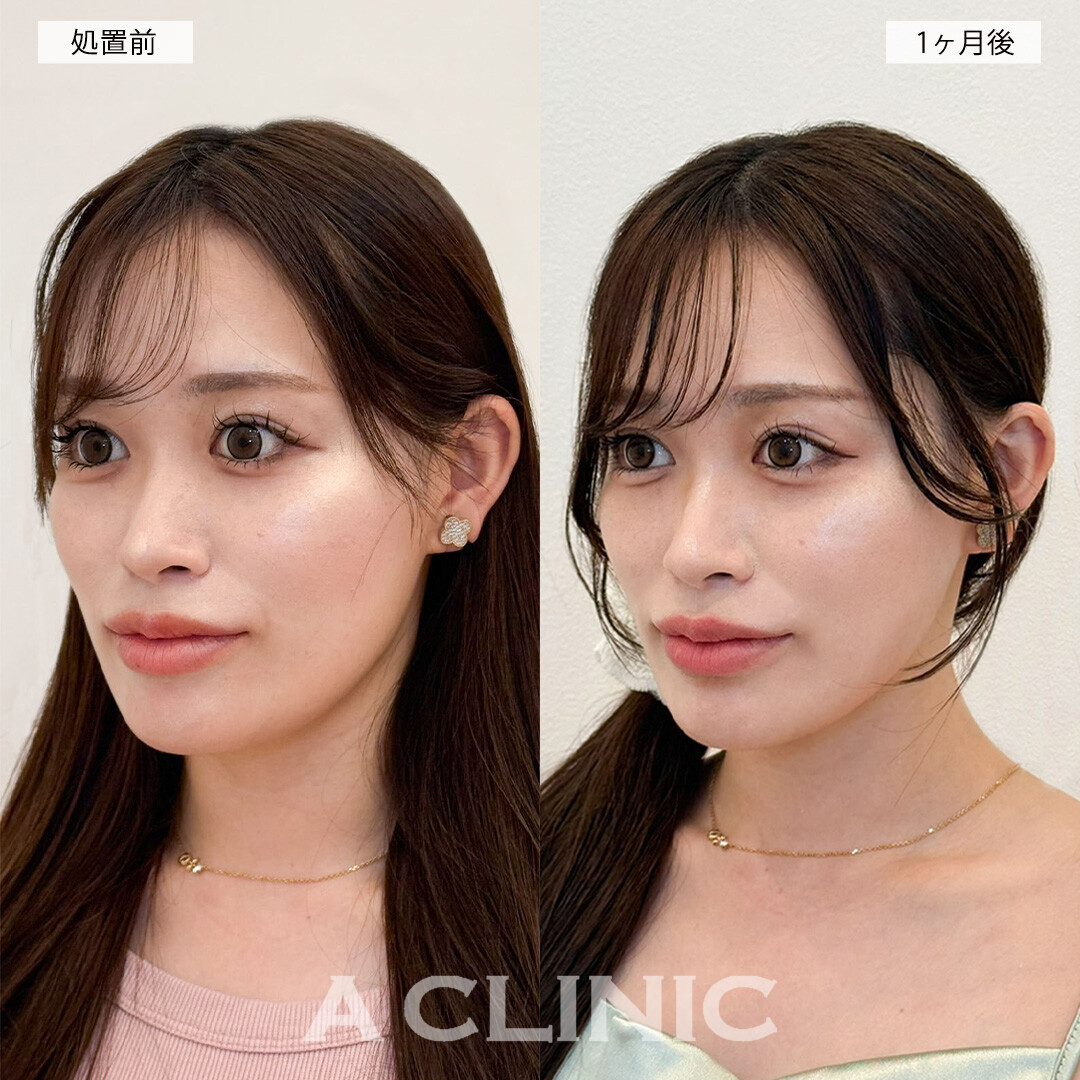 1day小顔脂肪吸引で輪郭の加工が不要になりました！こちら処置前と1ヶ月後の症例です(20代女性)