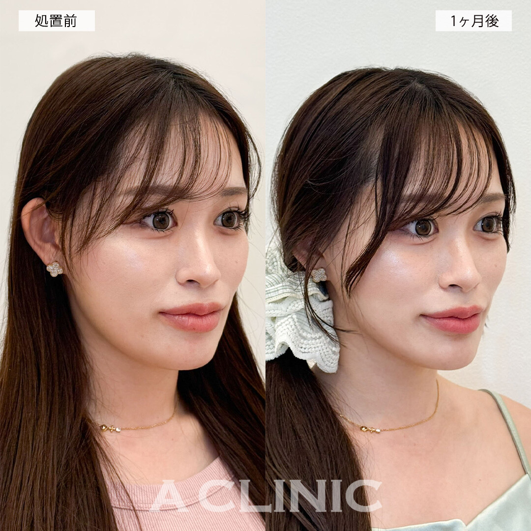 1day小顔脂肪吸引で輪郭の加工が不要になりました！こちら処置前と1ヶ月後の症例です(20代女性)