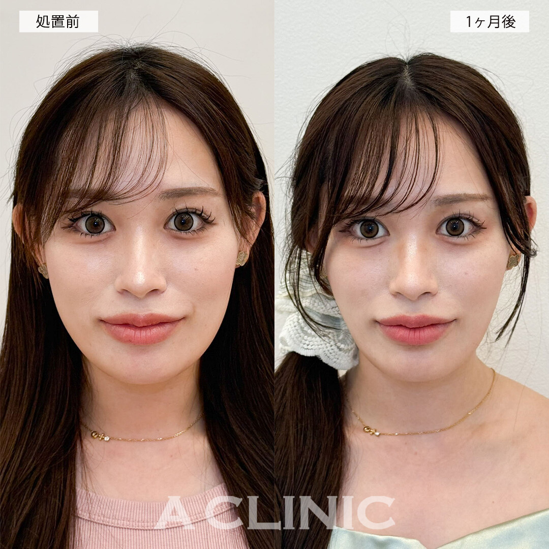 1day小顔脂肪吸引で輪郭の加工が不要になりました！こちら処置前と1ヶ月後の症例です(20代女性)