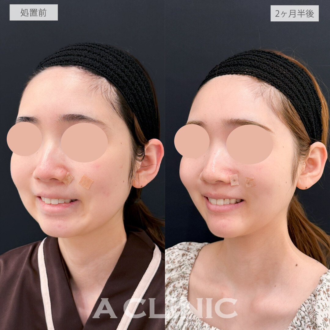 バッカルファット除去術と口角ボトックスで笑顔がより美しくなりました！処置前と2ヶ月半後の症例です(20代女性)