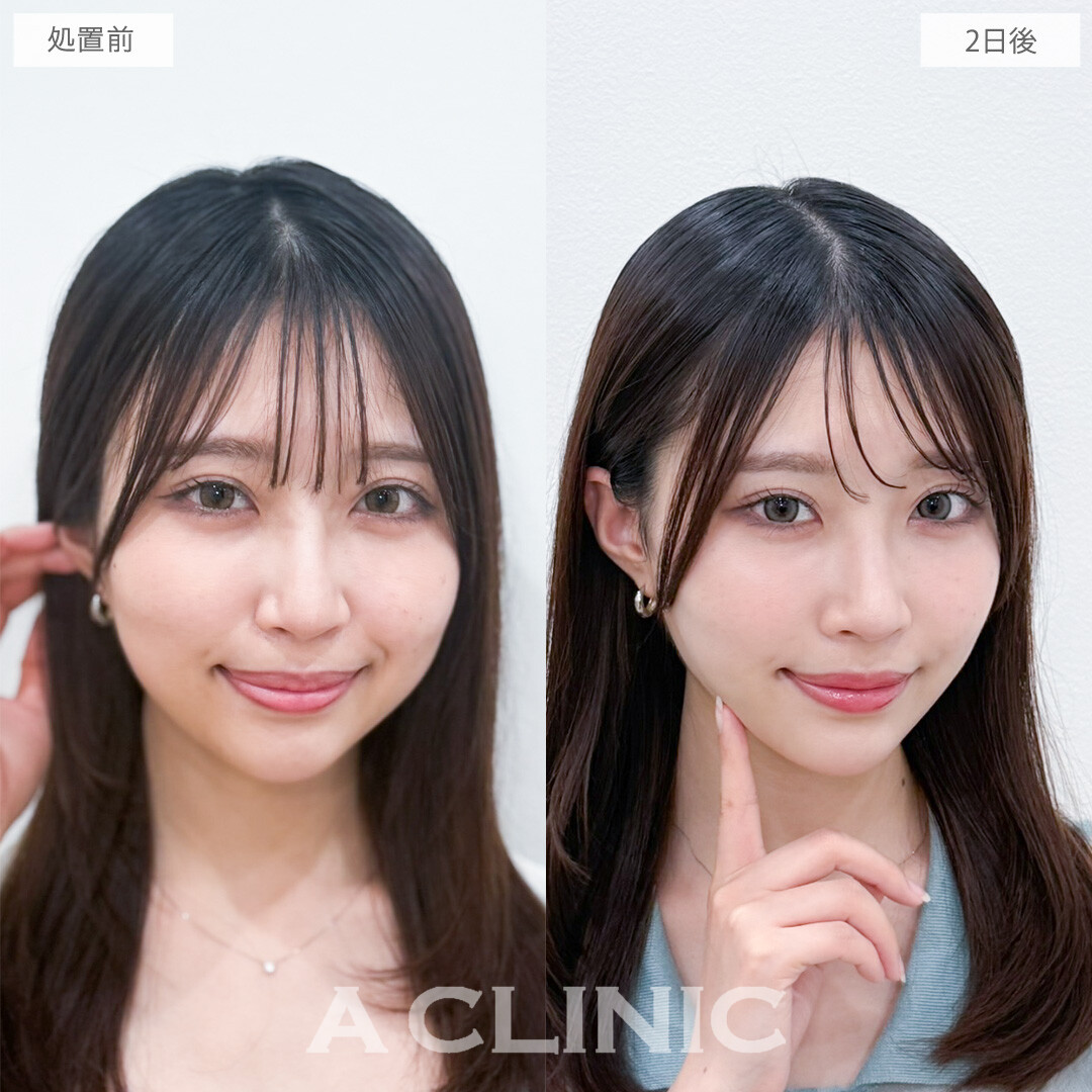 1day小顔脂肪吸引でダウンタイム中でもすでに小顔を実感！処置前と2日後の症例です(20代女性)