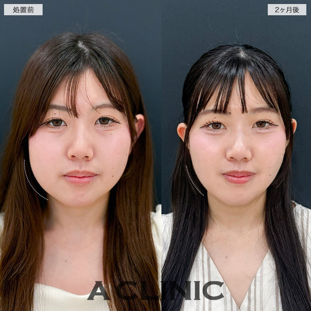 1day小顔脂肪吸引で余白をひとまわり小さく！処置前と2ヶ月後の症例です(20代女性)
