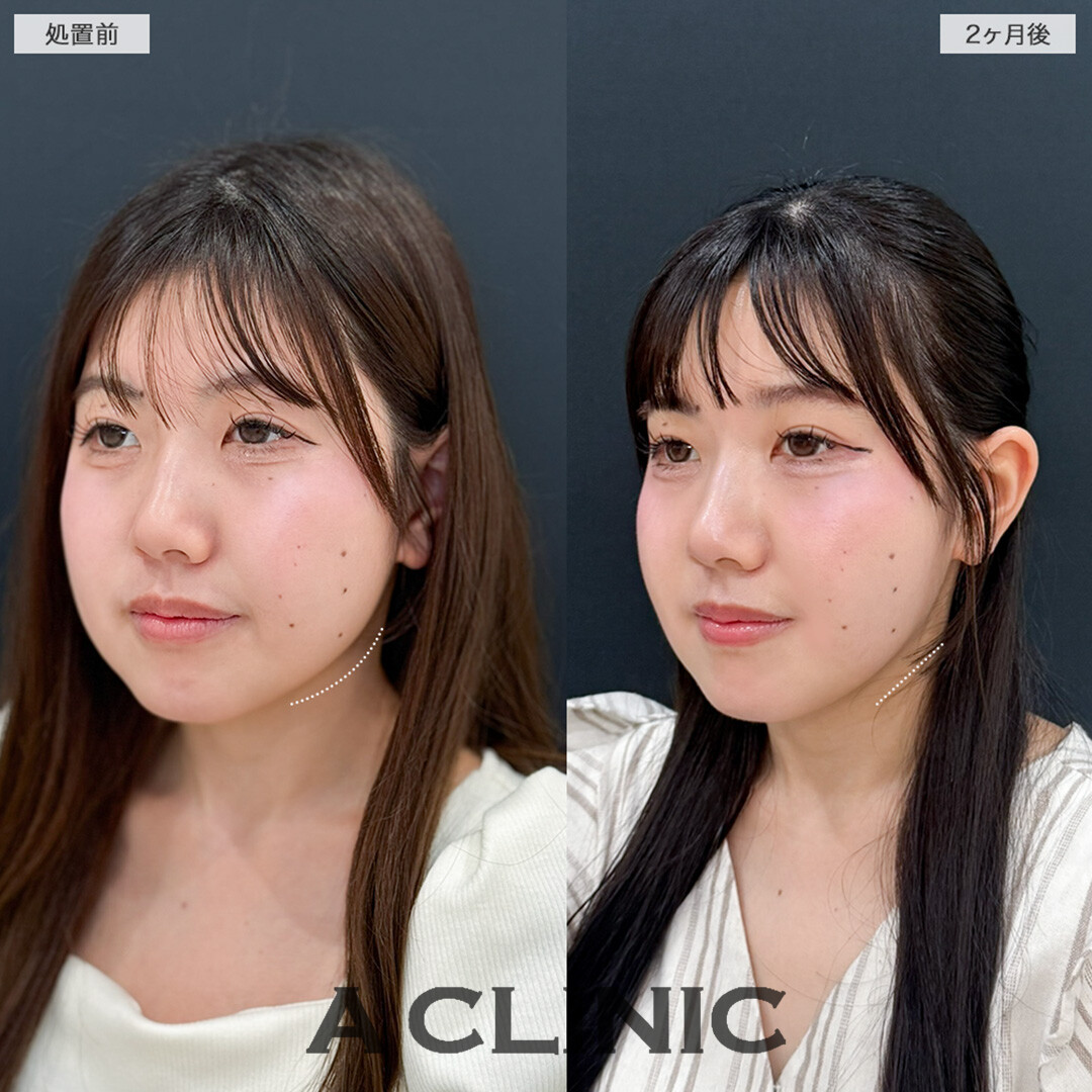 1day小顔脂肪吸引で余白をひとまわり小さく！処置前と2ヶ月後の症例です(20代女性)