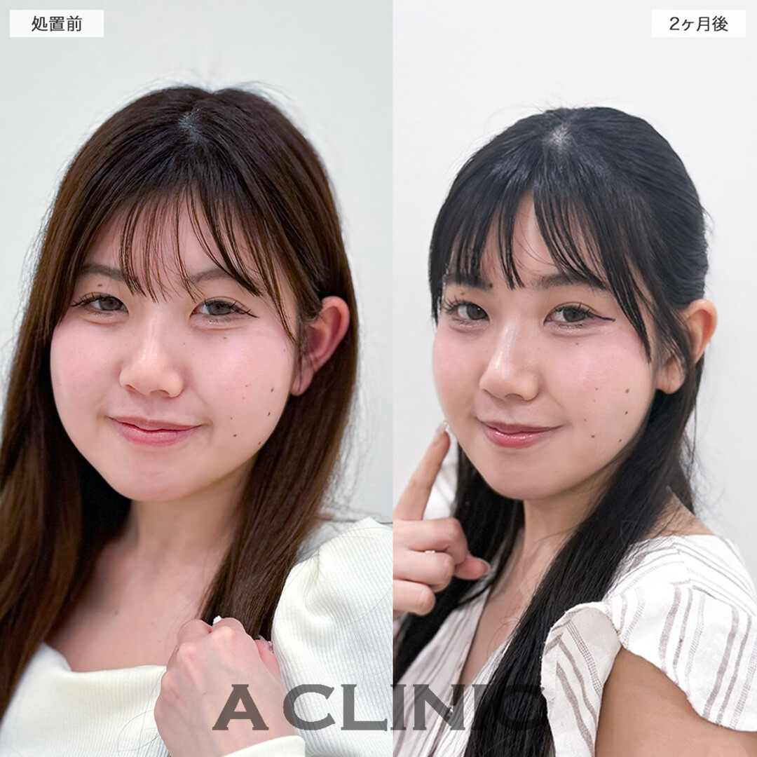 1day小顔脂肪吸引で余白をひとまわり小さく！処置前と2ヶ月後の症例です(20代女性)
