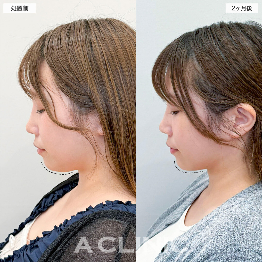 1day小顔脂肪吸引で全体的にスッキリとした小顔へ！処置前と2ヶ月後の症例です(30代女性)