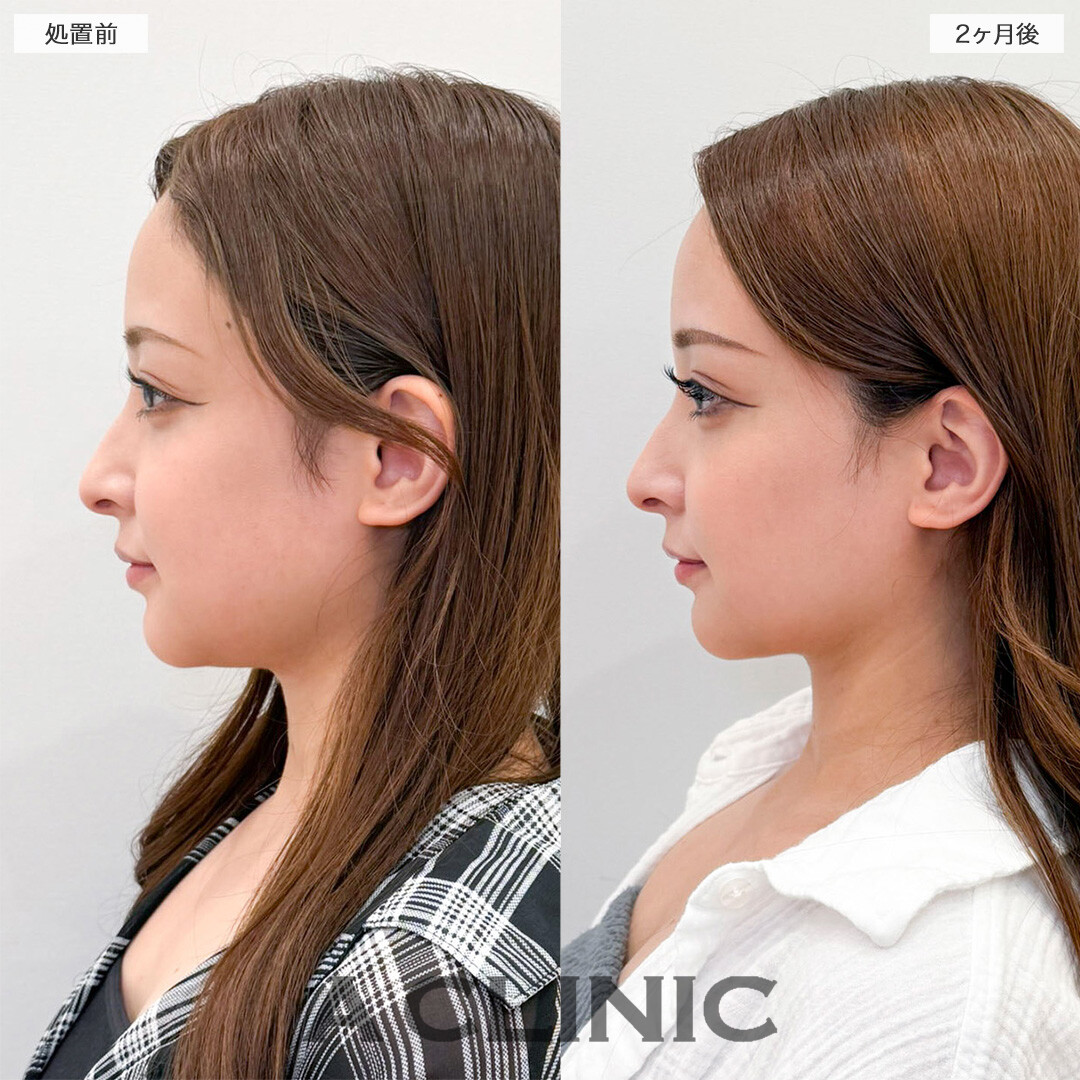 1day小顔脂肪吸引で写真写りが変わる！処置前と2ヶ月後の症例です(20代女性)