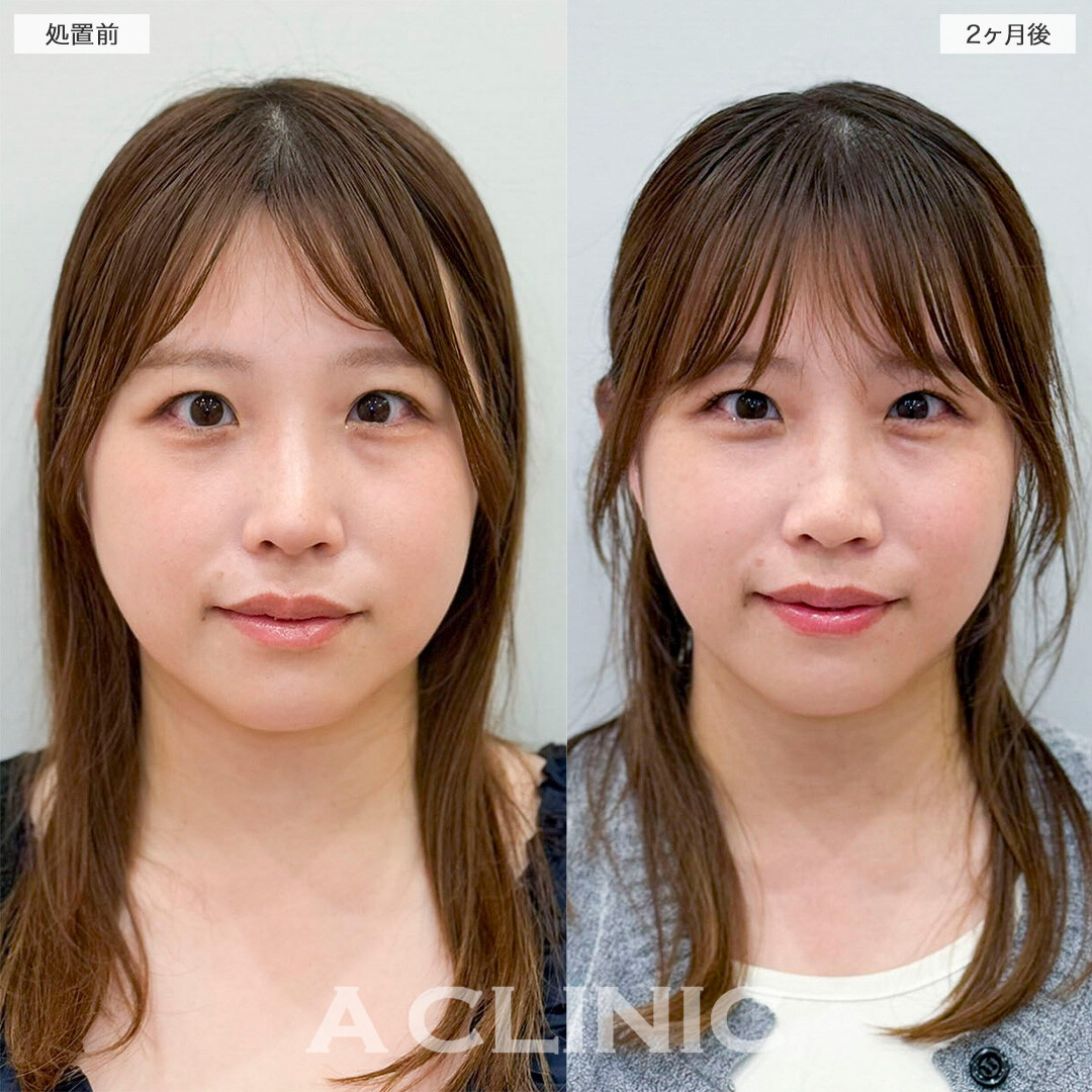 1day小顔脂肪吸引で全体的にスッキリとした小顔へ！処置前と2ヶ月後の症例です(30代女性)