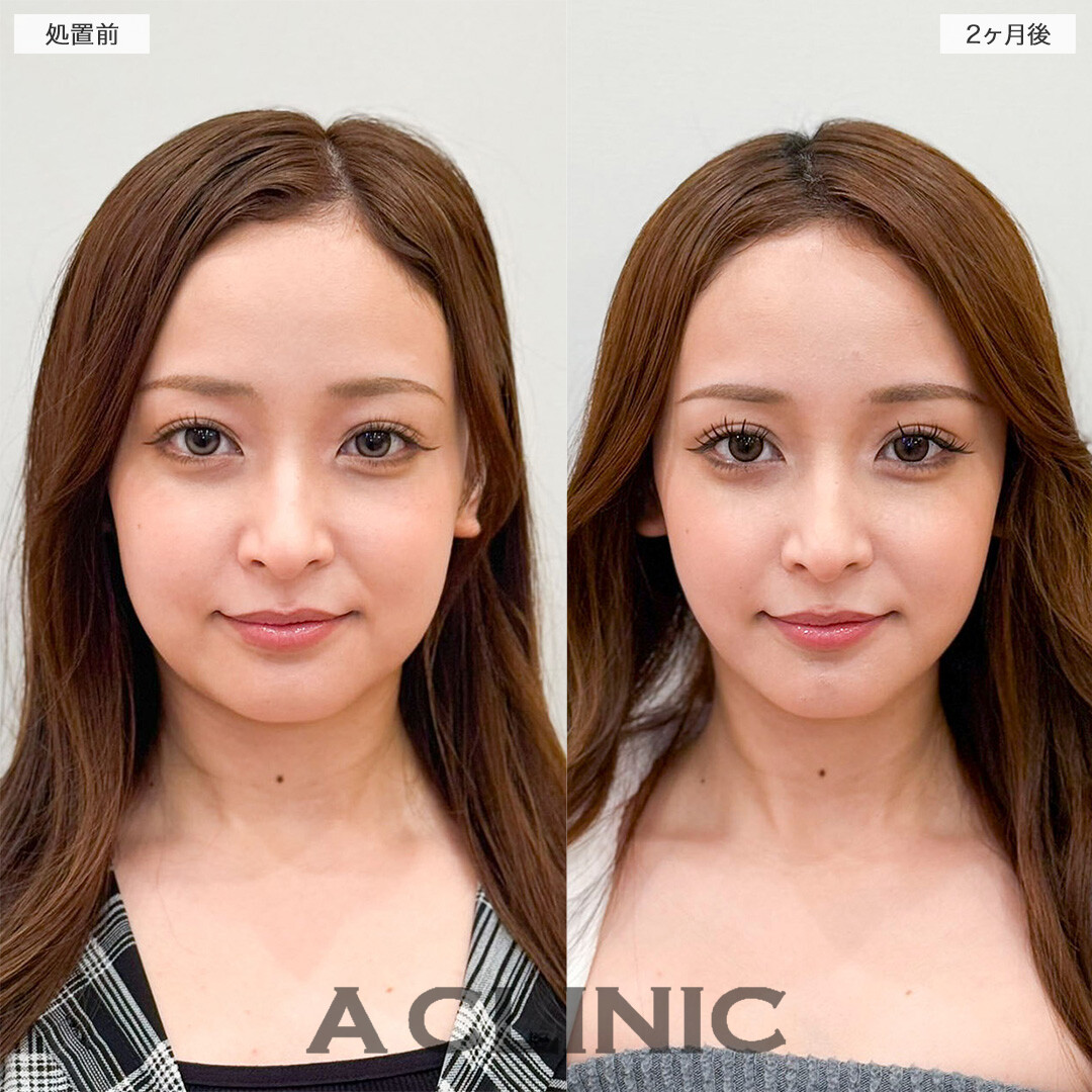 1day小顔脂肪吸引で写真写りが変わる！処置前と2ヶ月後の症例です(20代女性)