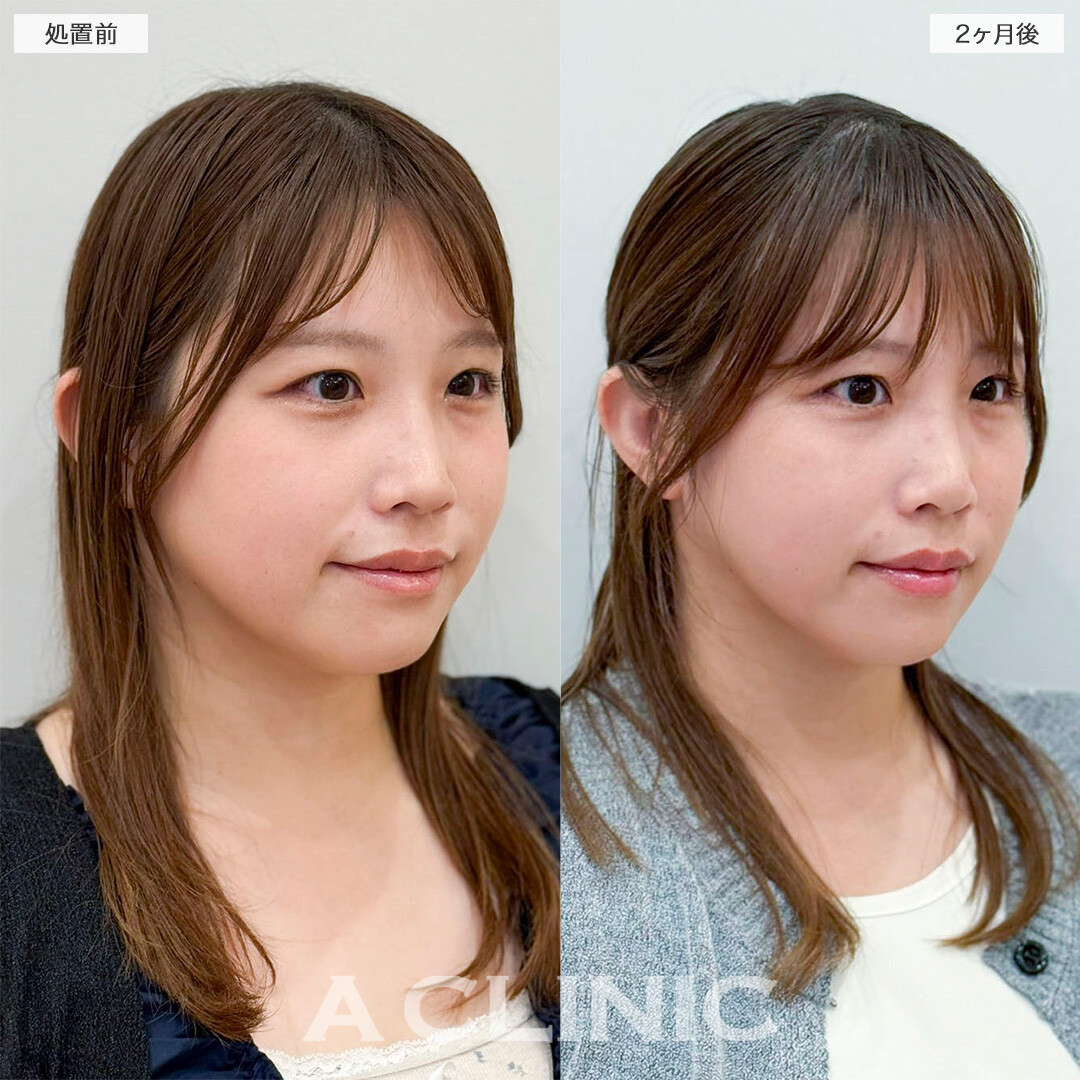 1day小顔脂肪吸引で全体的にスッキリとした小顔へ！処置前と2ヶ月後の症例です(30代女性)
