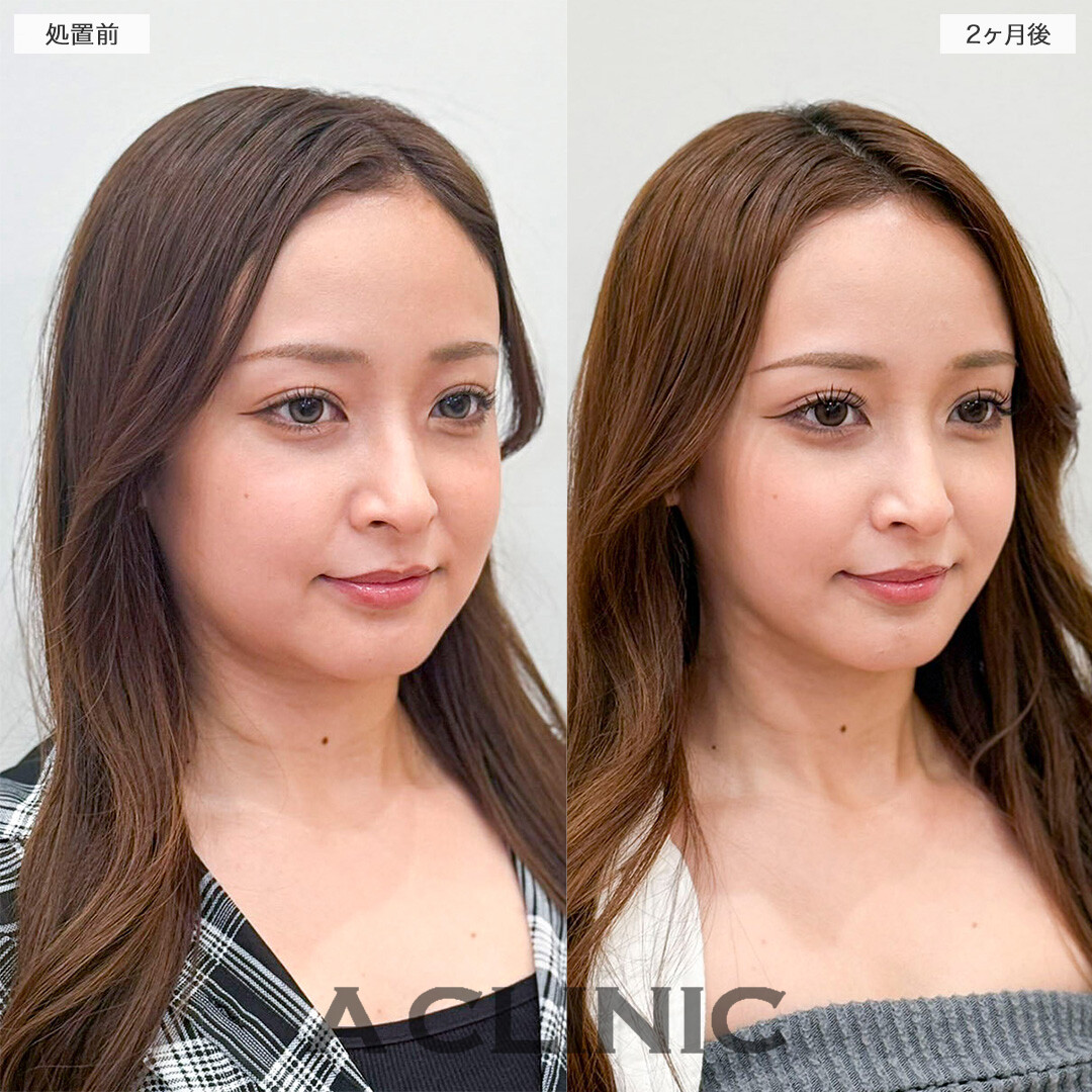 1day小顔脂肪吸引で写真写りが変わる！処置前と2ヶ月後の症例です(20代女性)