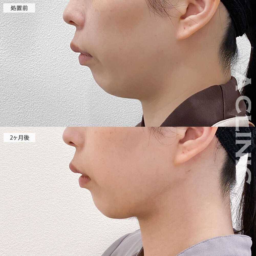 1day小顔脂肪吸引でアゴ下周辺のたるみが見違えるほどなくなりました！こちら処置前と2ヶ月後の症例です(30代女性)