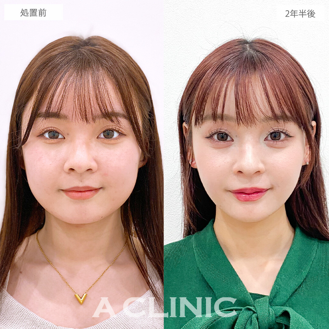 1day小顔脂肪吸引で後戻りを感じない自然な垢抜け小顔に！こちら処置前と2年半後の症例です(10代女性)