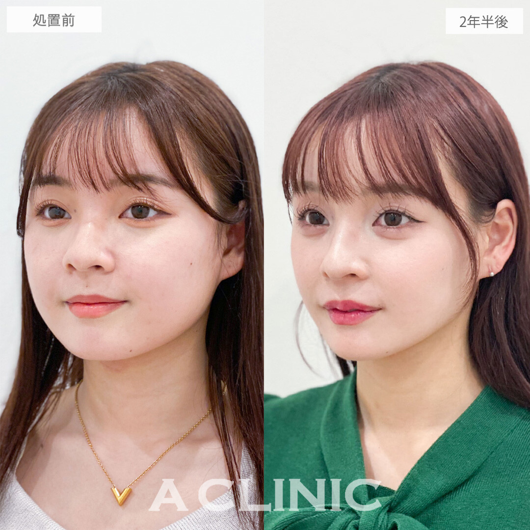 1day小顔脂肪吸引で後戻りを感じない自然な垢抜け小顔に！こちら処置前と2年半後の症例です(10代女性)