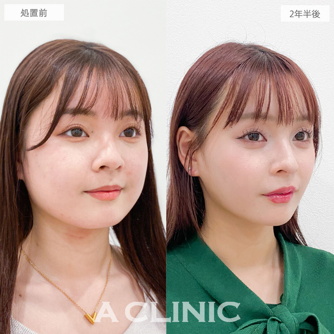 1day小顔脂肪吸引で後戻りを感じない自然な垢抜け小顔に！こちら処置前と2年半後の症例です(10代女性)